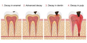 The Stages of Tooth Decay