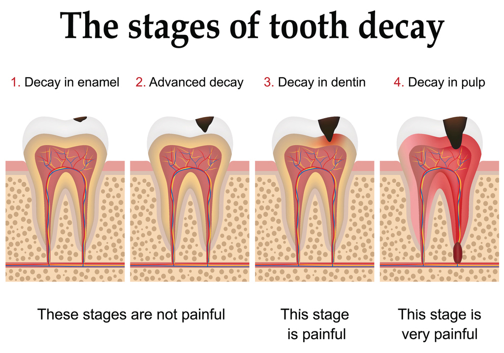 The Stages of Tooth Decay